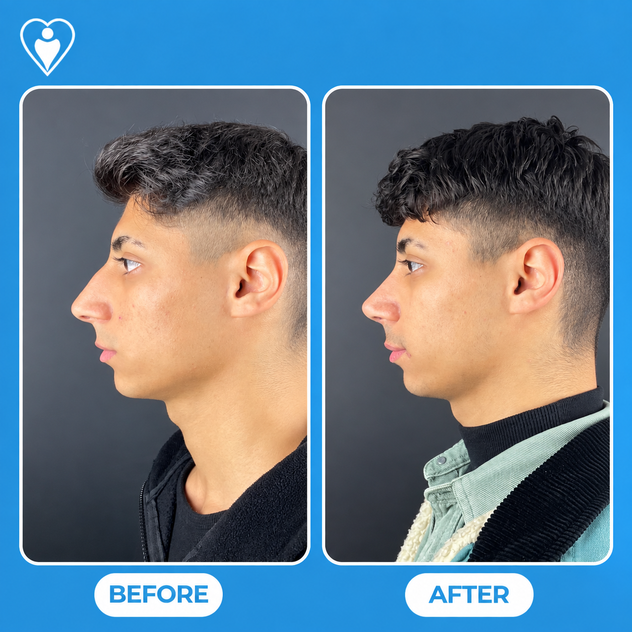 Nose reshaping surgery before and after: a young man's side profile before, and after rhinoplasty, patient of Assoc. Prof. Raşit Cevizci, Flymedi.