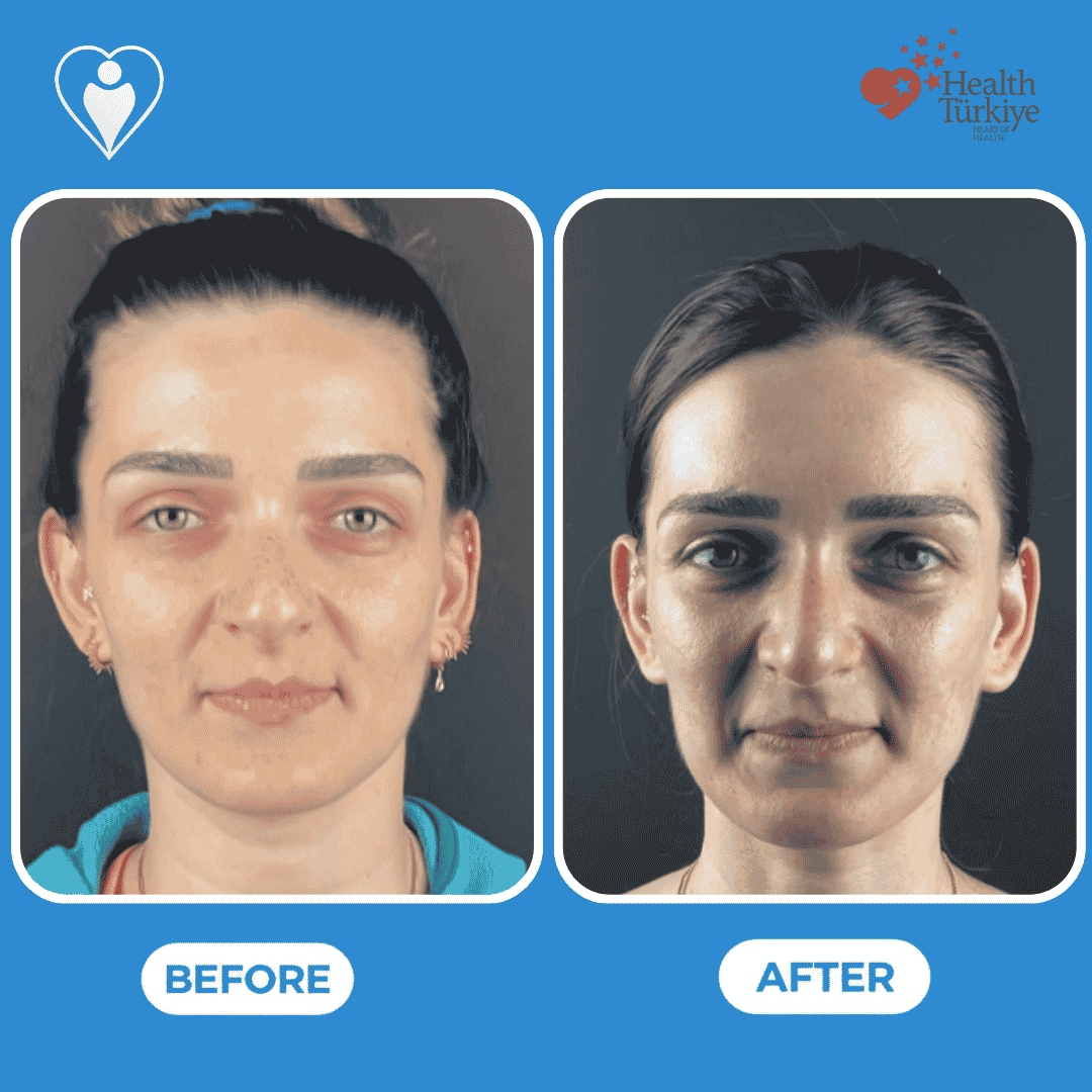 Rhinoplasty before and after: a woman's front view before, and after nose reshaping, patient of Assoc. Prof. Raşit Cevizci, Flymedi.