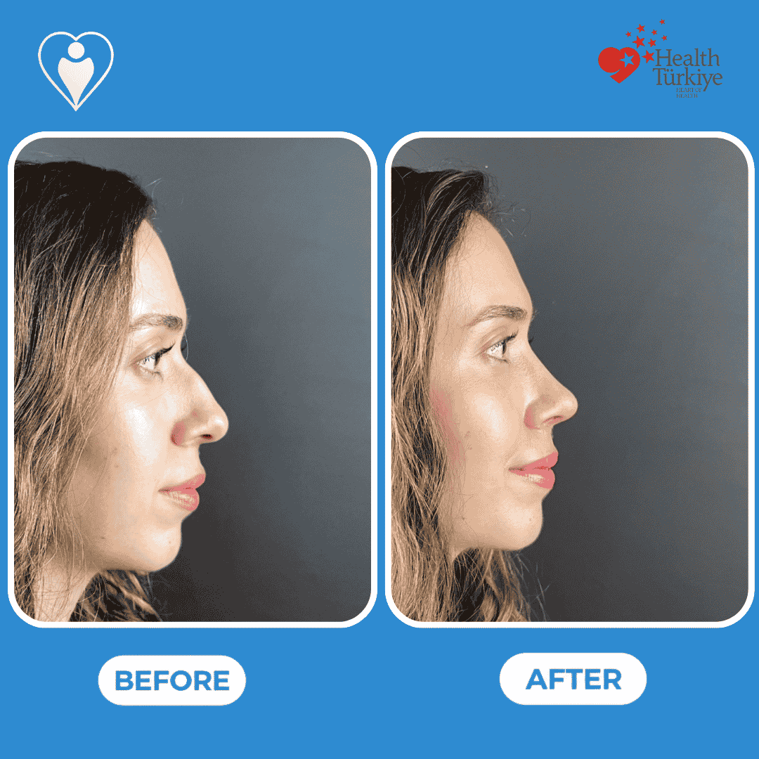 Rhinoplasty before and after: a woman's side profile before, and after nose reshaping, patient of Assoc. Prof. Raşit Cevizci, Flymedi.