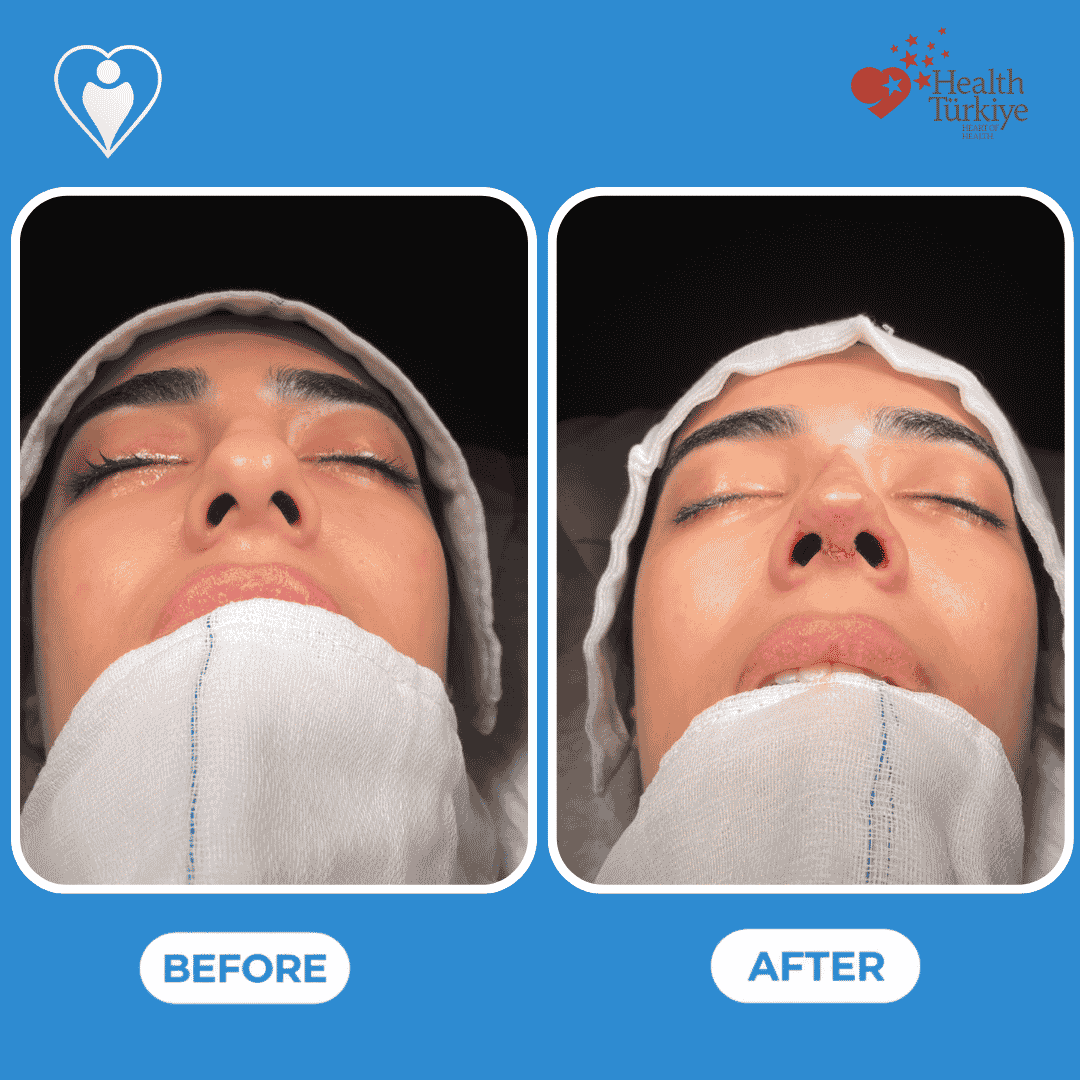 Nose surgery before and after: a close-up clinical view before, and after rhinoplasty, patient of Assoc. Prof. Raşit Cevizci, Flymedi.