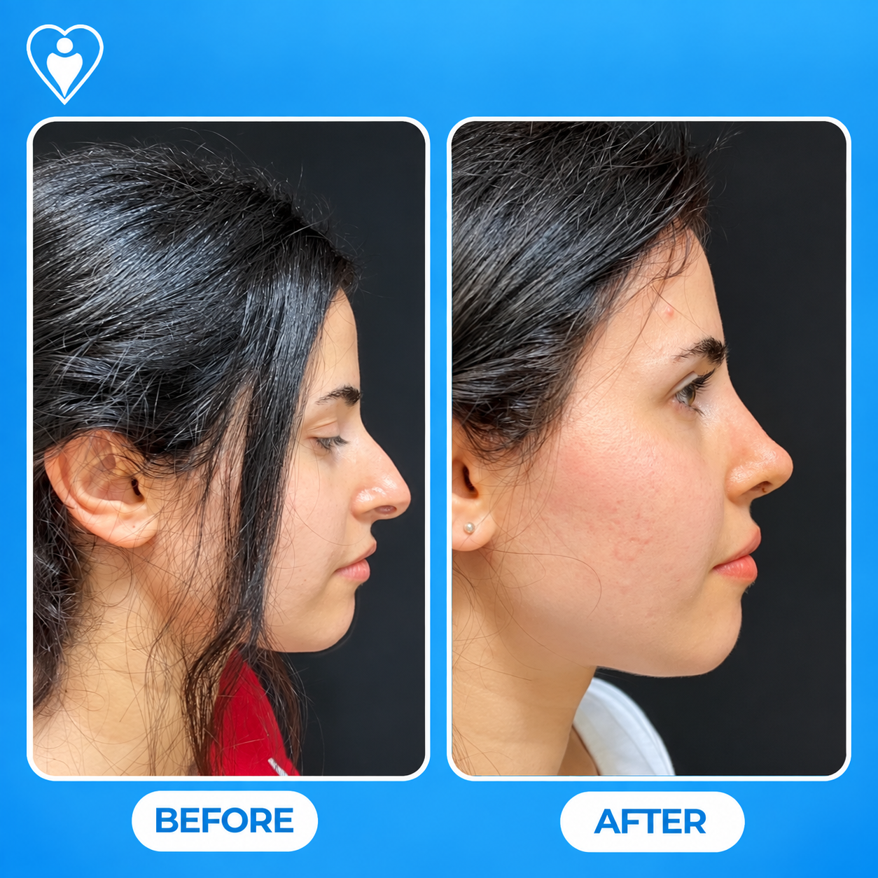 Rhinoplasty before and after: a woman's side profile before, and after nose reshaping, patient of Dr. Songül Dursun, Flymedi.