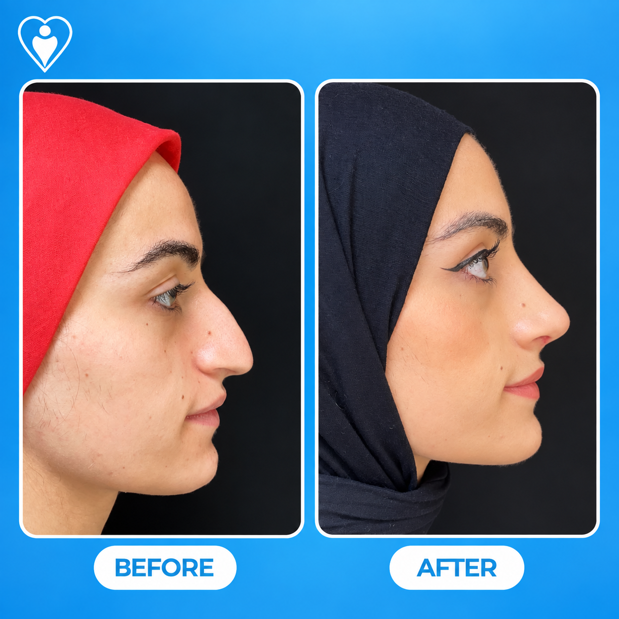 Nose surgery before and after: a woman in a red headscarf before, and in a black headscarf after rhinoplasty, patient of Dr. Songül Dursun, Flymedi.