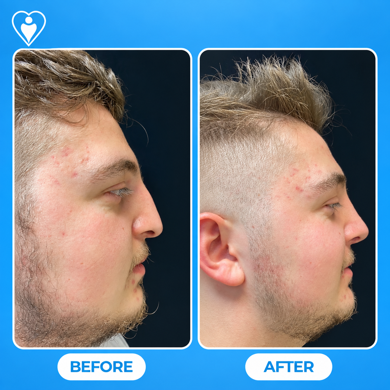 Rhinoplasty in Turkey, before and after: a young man's side profile before, and after nose reshaping, patient of Dr. Songül Dursun, Flymedi.