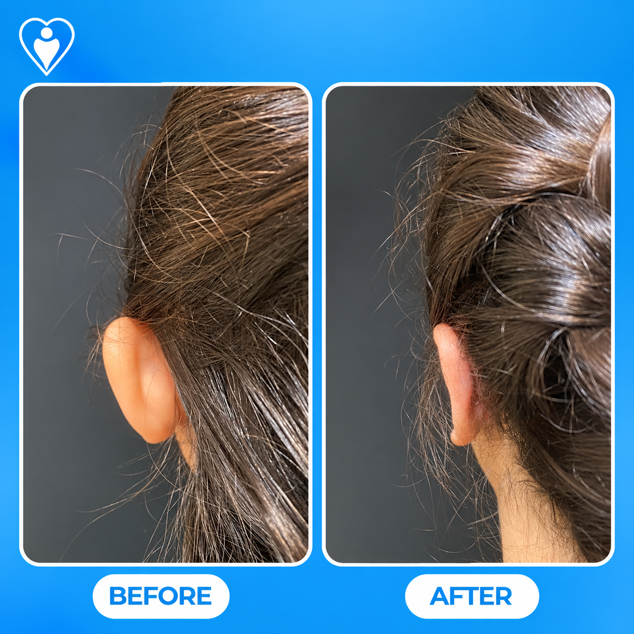 Otoplasty before and after: a close-up of the ear before, and after ear reshaping surgery, patient of Dr. Songül Dursun, Flymedi.