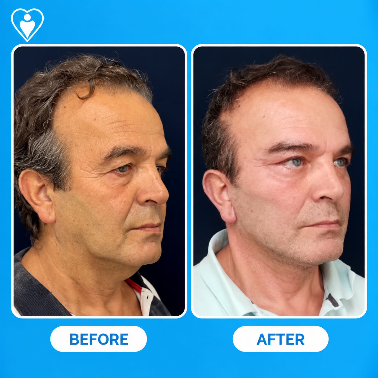 Facelift vorher und nachher: das Seitenprofil eines Mannes vorher, und nach der Gesichtsverjüngung, Patient von Dr. Şuheda Çıldır, Flymedi.