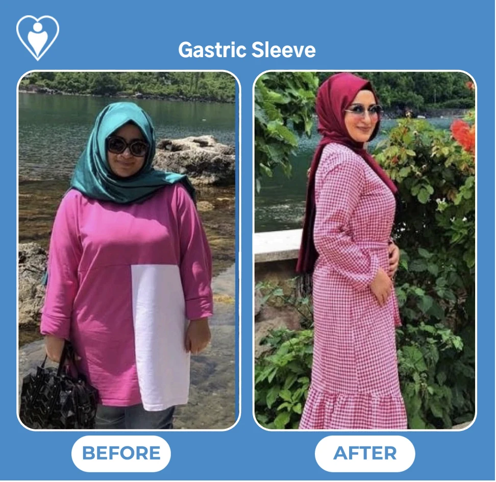 Gastric sleeve before and after: a woman in a pink tunic and headscarf by the sea before, and in a checked dress after, patient of Dr. Taalaibek Sydykov, Flymedi.
