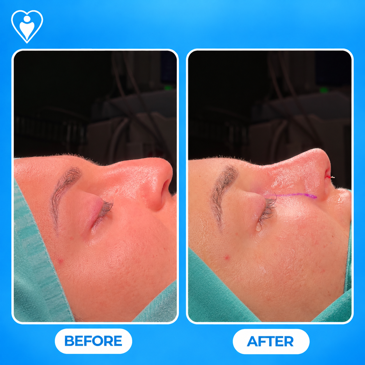Rhinoplasty before and after: a clinical close-up before, and with visible sutures after nose surgery, patient of Op. Dr. Teoman Eraslan, Flymedi.