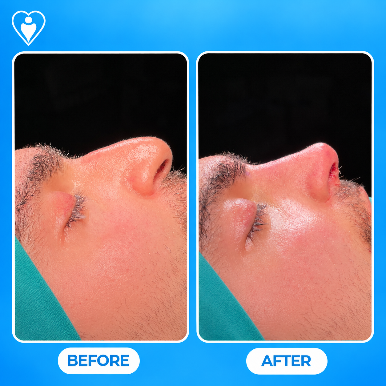 Nose surgery before and after: a clinical close-up before, and after rhinoplasty, patient of Op. Dr. Teoman Eraslan, Flymedi.