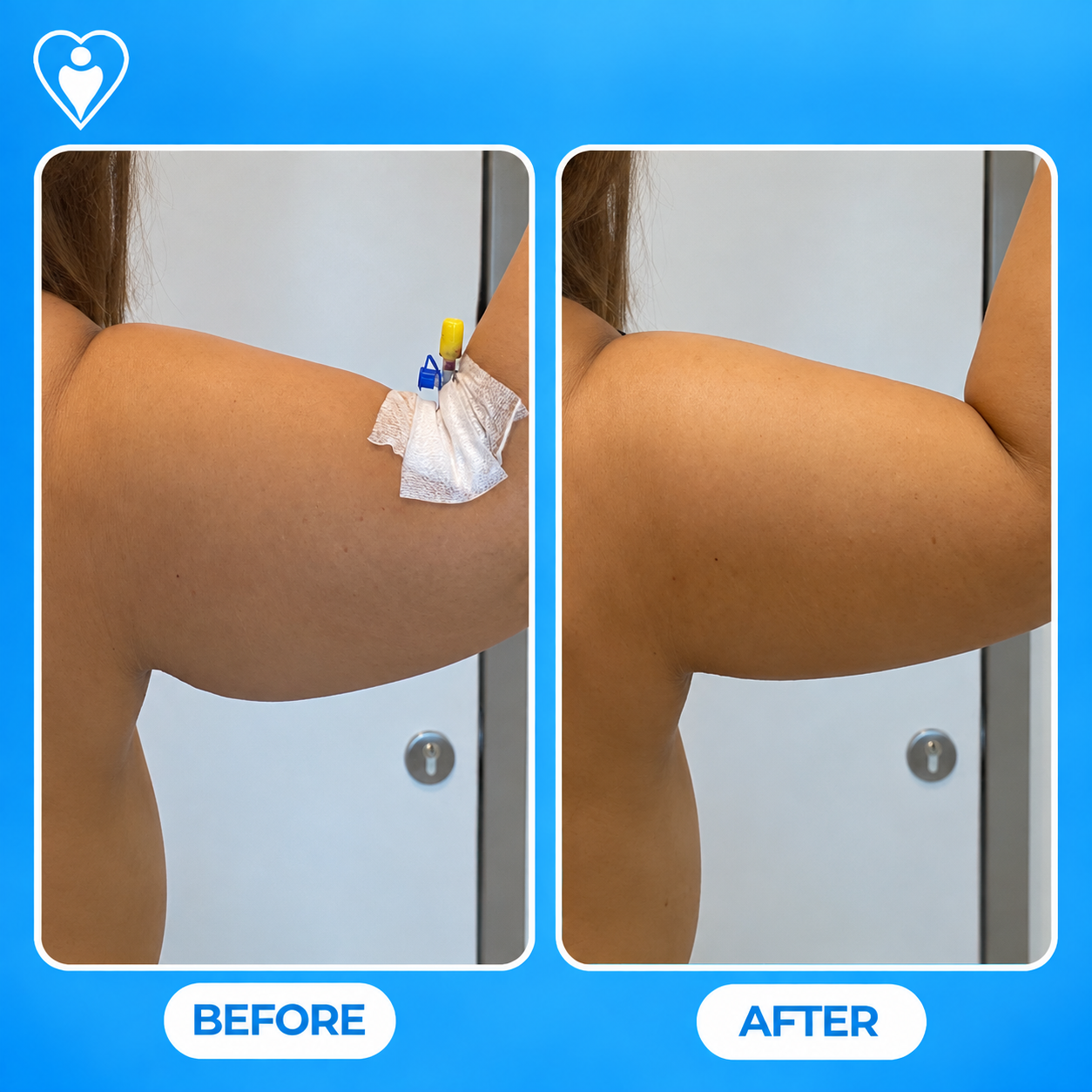 Arm lift before and after: a woman's arm with surgical drain before, and a smoother contour after, patient of Op. Dr. Teoman Eraslan, Flymedi.