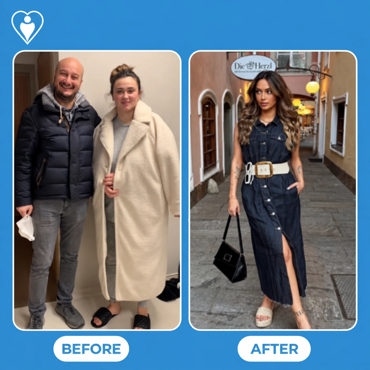 Bariatric surgery before and after: a woman in a cream coat at the clinic before, and in a denim dress on a street after, patient of Prof. Toygar Toydemir, Flymedi.