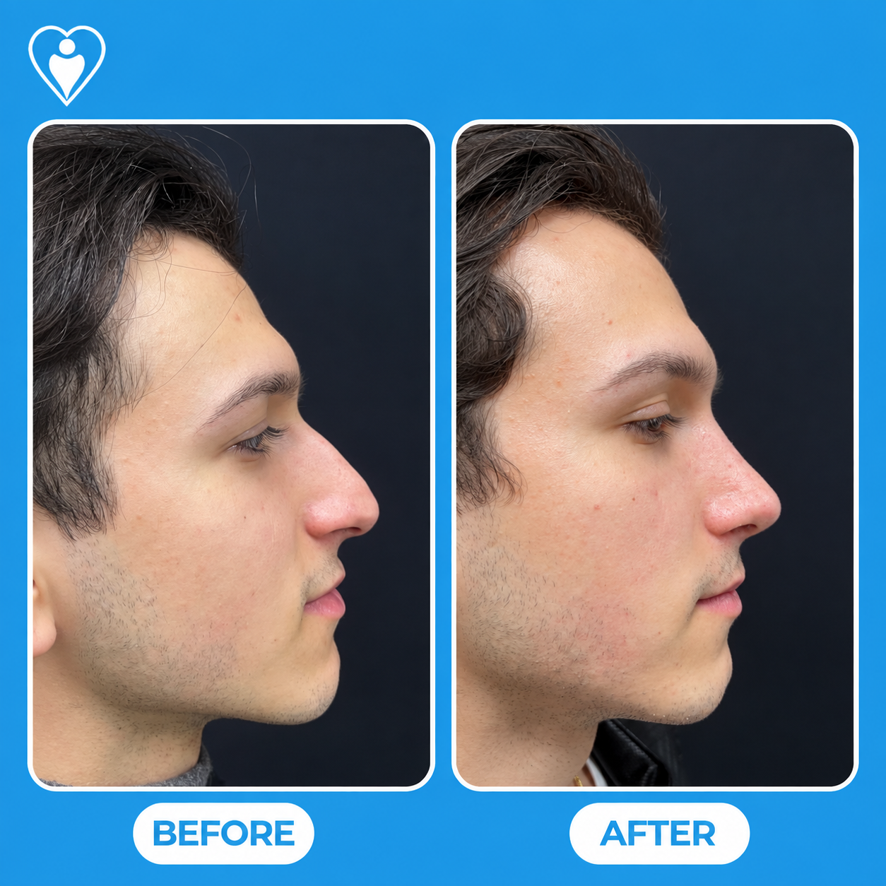 Rhinoplasty before and after: a young man's side profile before, and after nose reshaping, patient of Assoc. Prof. Tuğçe Şimşek, Flymedi.