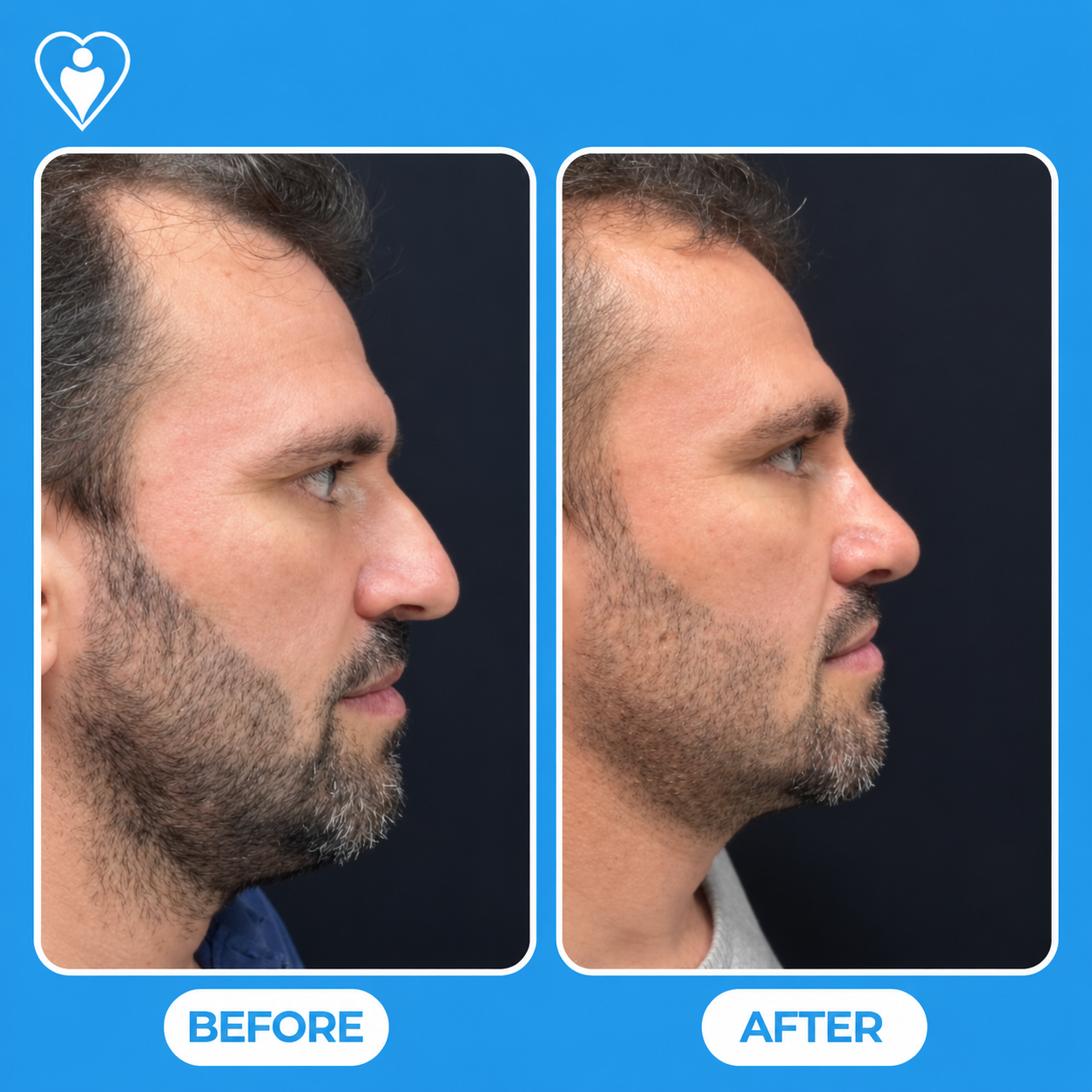 Nose surgery before and after: a man's side profile before, and after rhinoplasty, patient of Assoc. Prof. Tuğçe Şimşek, Flymedi.