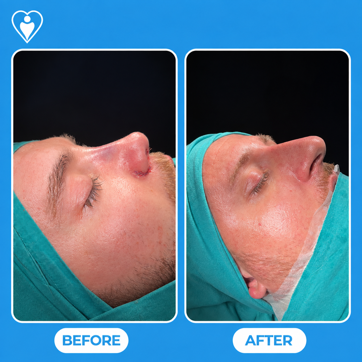 Rhinoplasty in Turkey, before and after: a clinical close-up before, and after nose surgery, patient of Assoc. Prof. Tuğçe Şimşek, Flymedi.