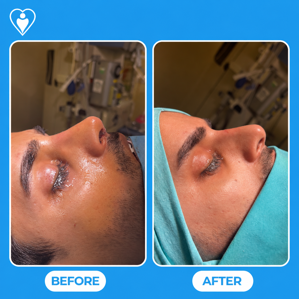 Nose reshaping surgery before and after: a clinical close-up before, and after rhinoplasty, patient of Assoc. Prof. Tuğçe Şimşek, Flymedi.