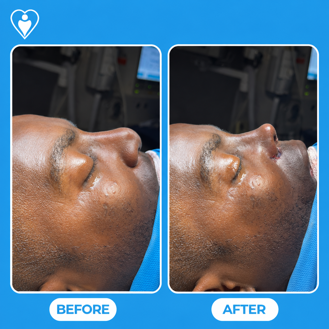 Rhinoplasty before and after: a clinical close-up before, and after nose surgery, patient of Assoc. Prof. Tuğçe Şimşek, Flymedi.