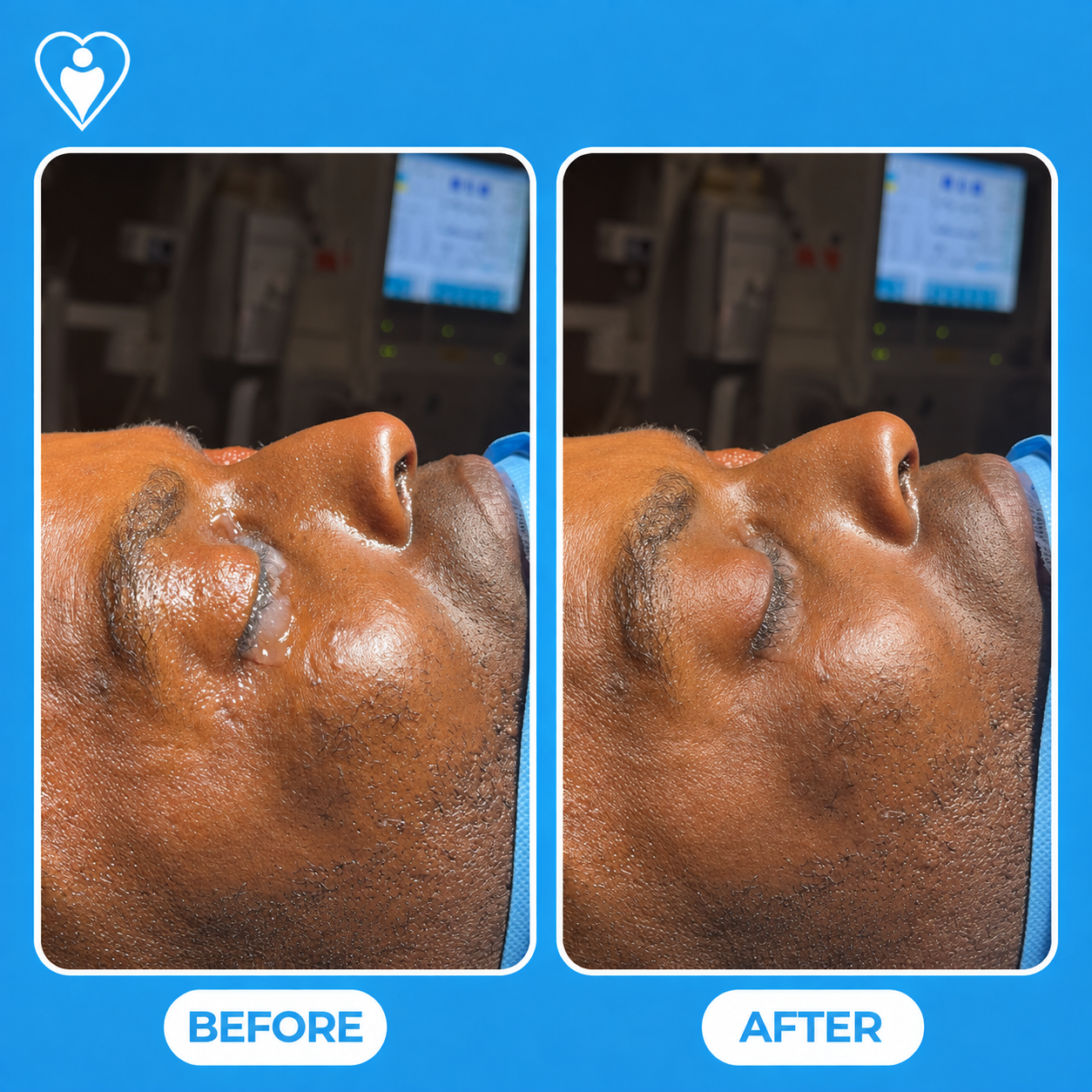 Nose surgery before and after: a close-up clinical view before, and after rhinoplasty, patient of Assoc. Prof. Tuğçe Şimşek, Flymedi.
