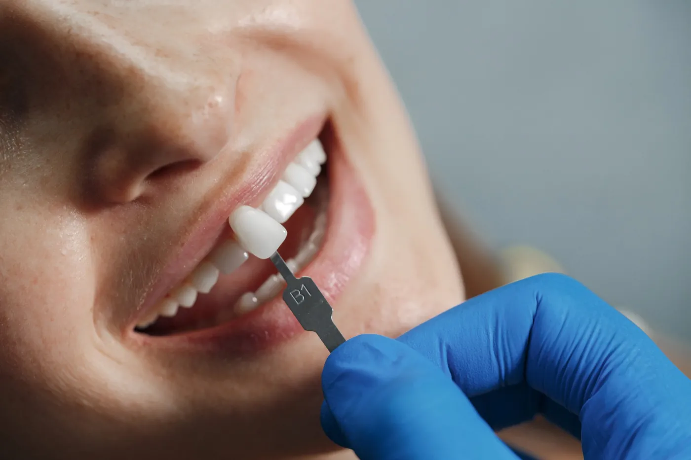 Cover image for What are Turkey teeth? Crowns, veneers and what the term really means