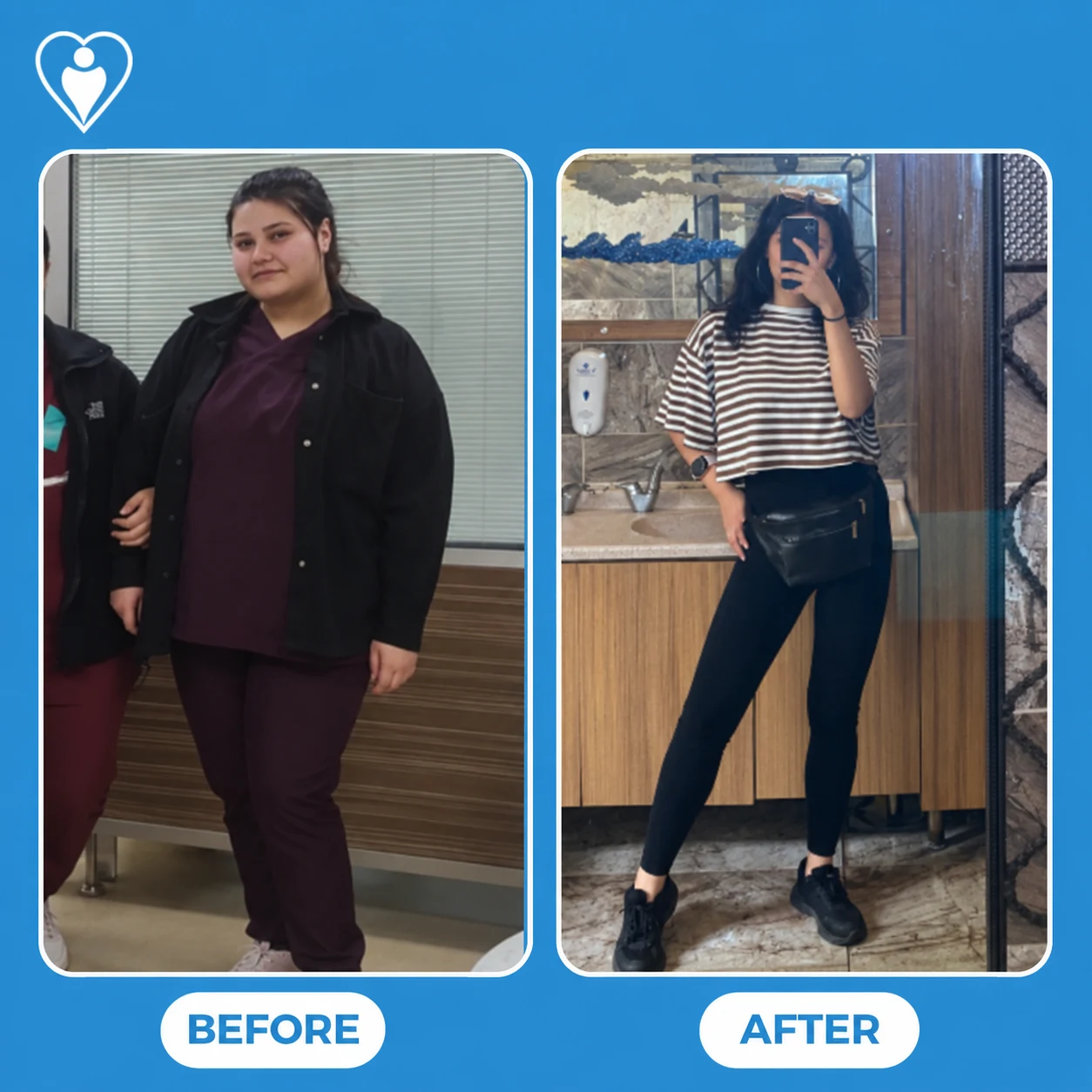 Chirurgia bariatrica a Istanbul, prima e dopo: una donna in divisa da lavoro prima, e in maglia a righe in un selfie allo specchio dopo, paziente del Dr. Volkan Tümentemur, Flymedi.