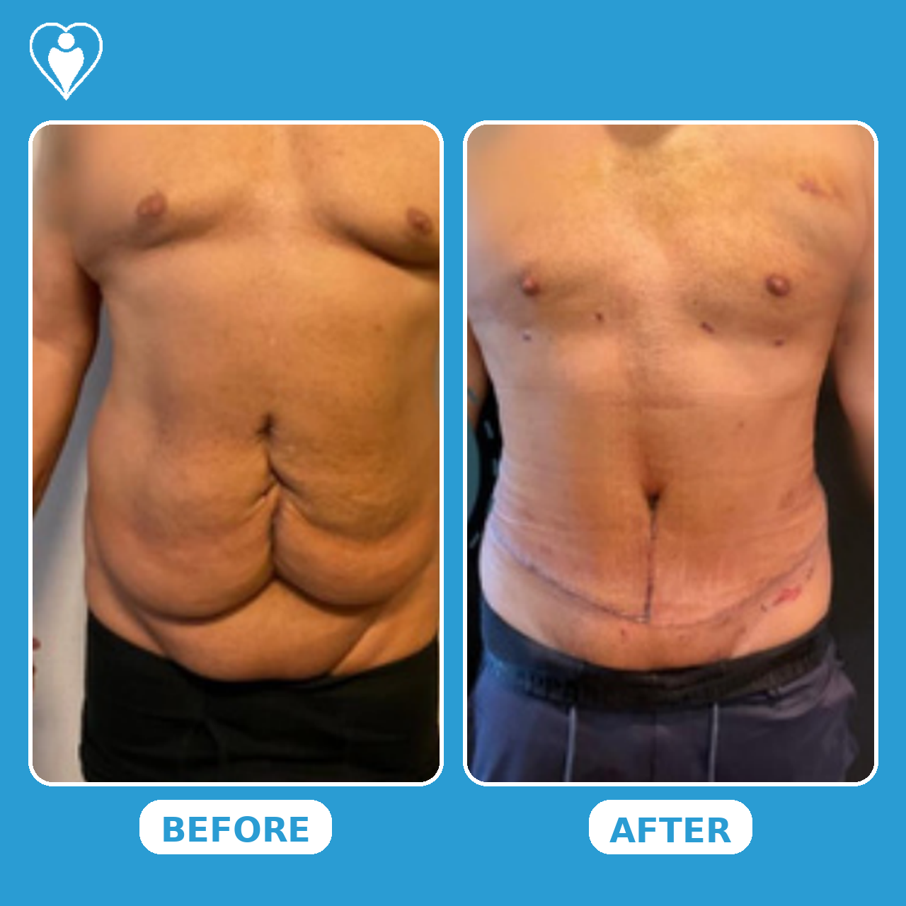 Bauchdeckenstraffung vorher und nachher: der Bauch eines Mannes vorher, und nach der Abdominoplastik, Patient von Assoc. Prof. Yalçın Bayram, Flymedi.