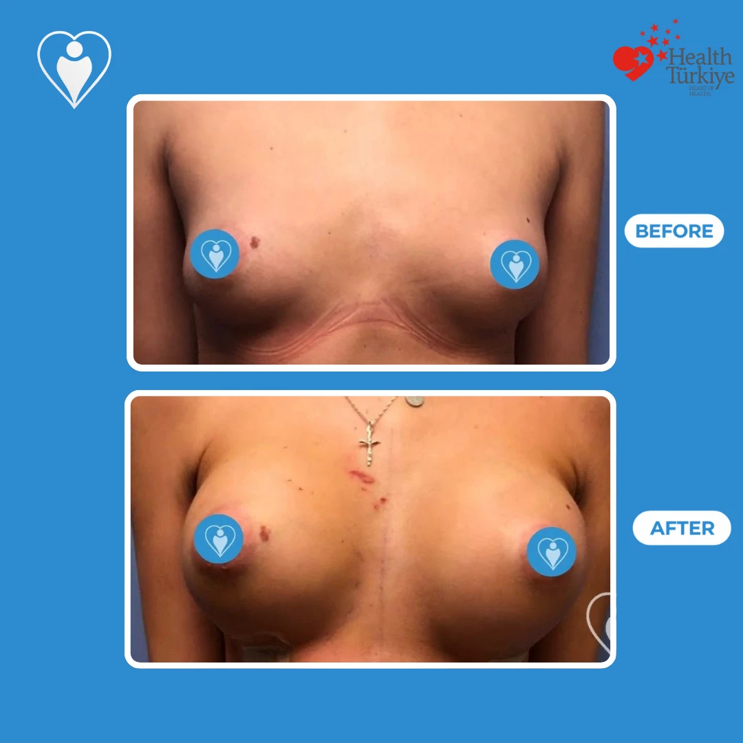 Plastic surgery in Istanbul, before and after: front view of small breasts before and a fuller shape soon after surgery, with skin markings, patient of Prof. Zeynep Sevim, Flymedi.