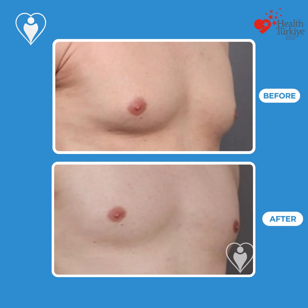 Male chest surgery before and after: angled view of a man's chest with enlarged breast tissue before and a flatter contour after, patient of Prof. Zeynep Sevim, Flymedi.