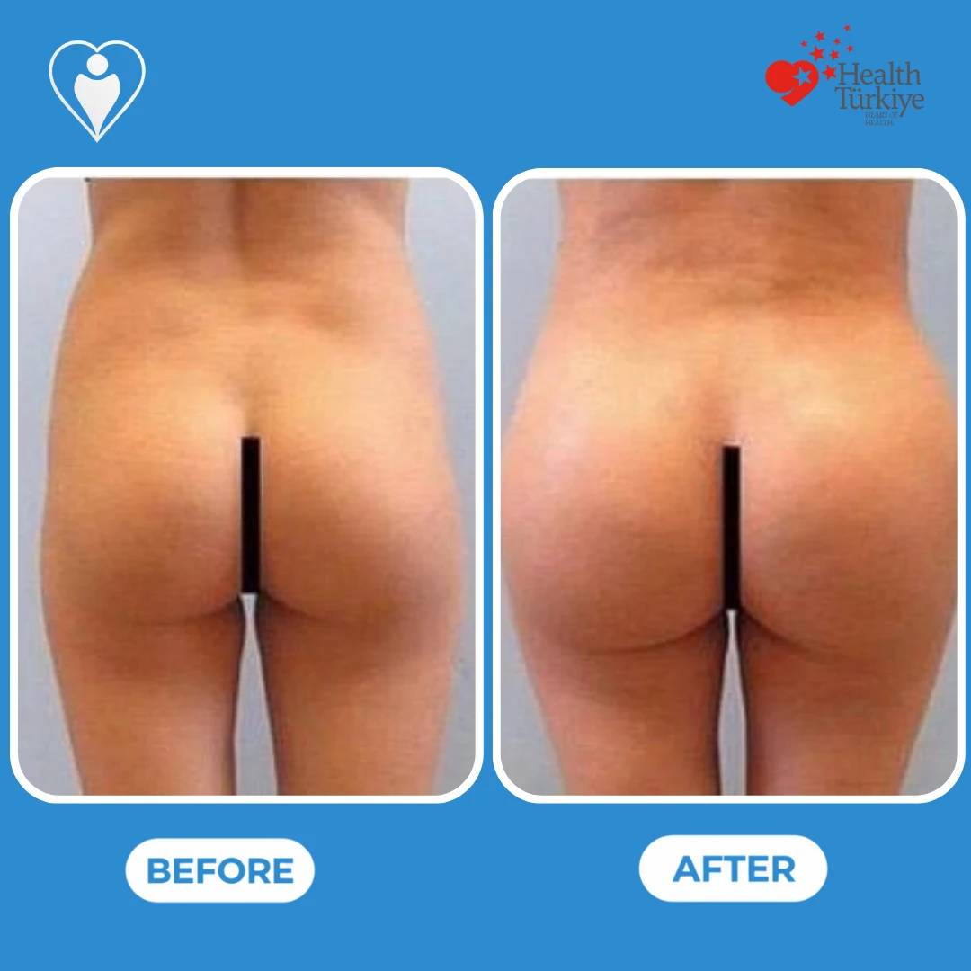 Buttock surgery before and after: back view of a woman's buttocks before and after, with a rounder, fuller shape, patient of Prof. Zeynep Sevim, Flymedi.