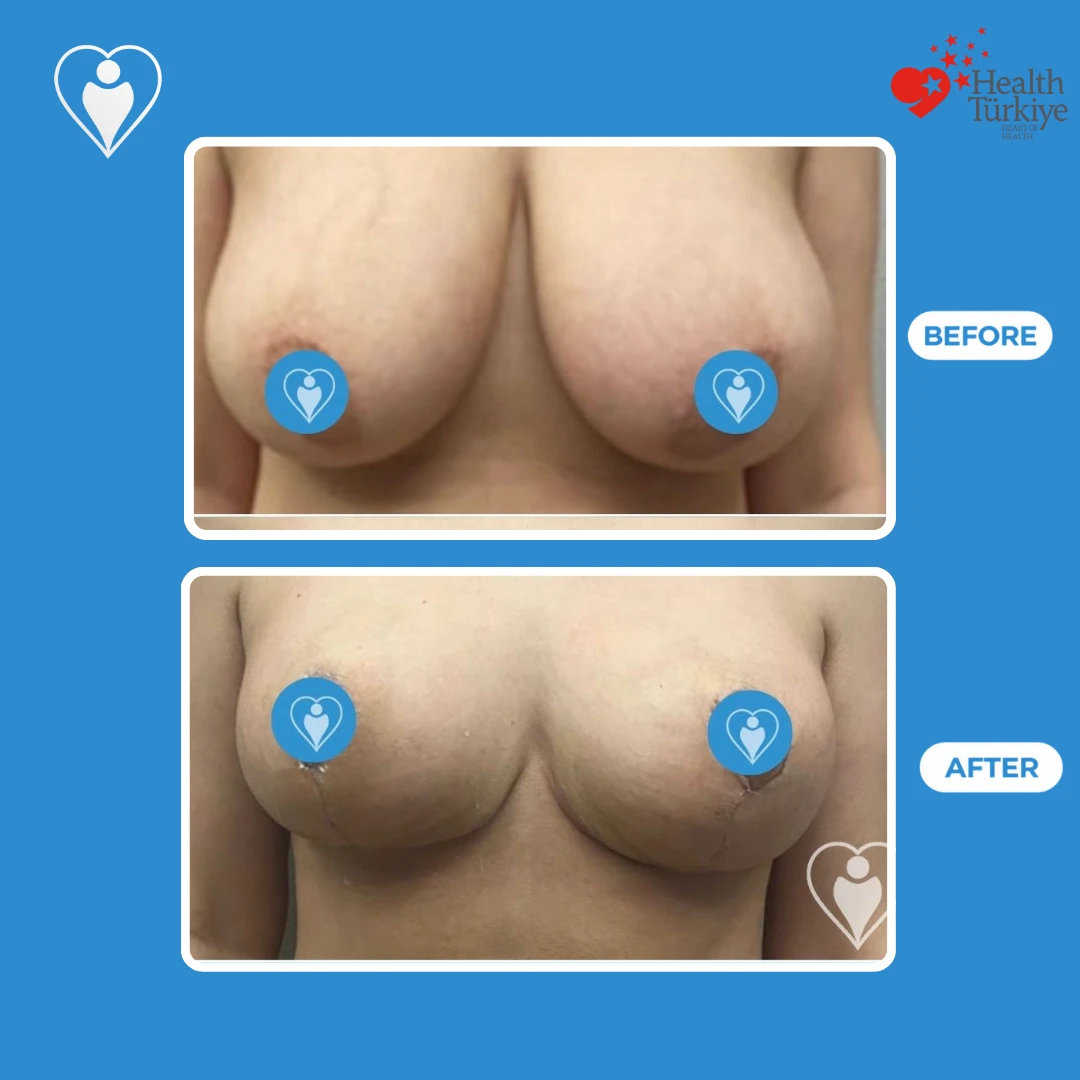 Breast surgery in Istanbul, before and after: front view of heavy, low breasts before and a higher, firmer shape after, with fine vertical scars, patient of Prof. Zeynep Sevim, Flymedi.