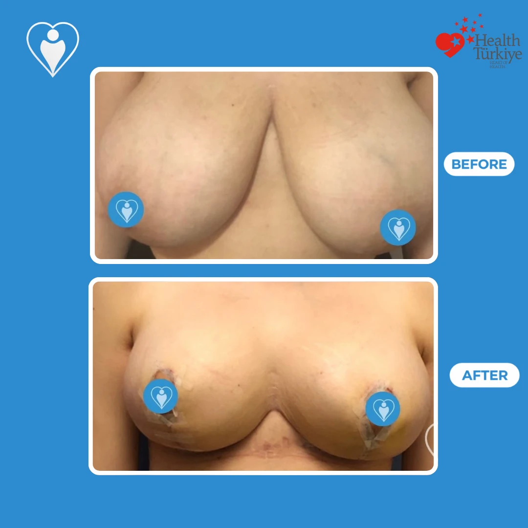 Plastic surgery before and after: front view of very large breasts before and a smaller, rounder shape soon after surgery, with small dressings, patient of Prof. Zeynep Sevim, Flymedi.