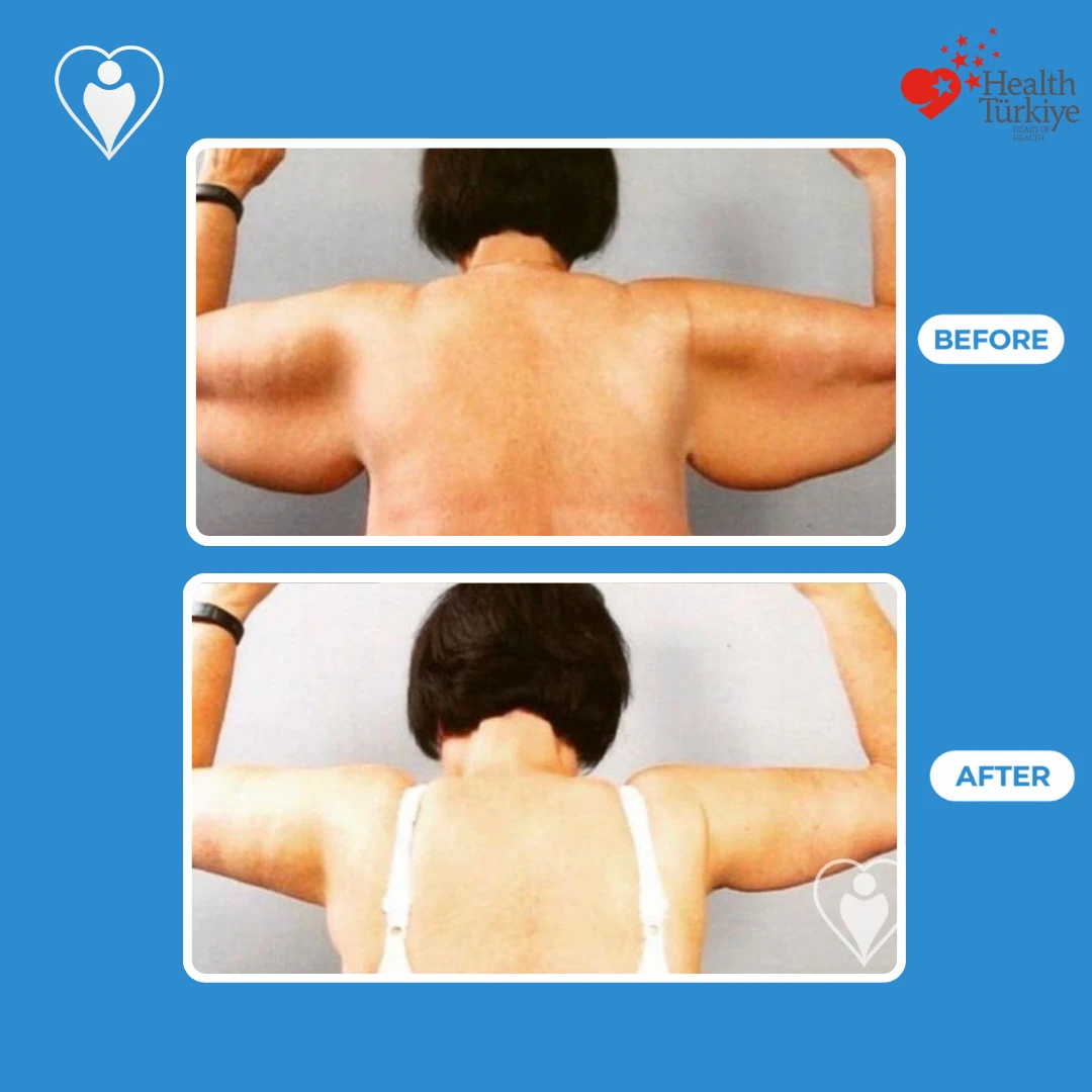 Arm surgery before and after: back view of a woman with raised arms before and after, with slimmer, firmer upper arms, patient of Prof. Zeynep Sevim, Flymedi.