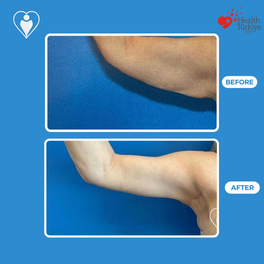 Arm surgery in Turkey, before and after: side view of a raised upper arm with loose skin before and a tighter contour after, patient of Prof. Zeynep Sevim, Flymedi.