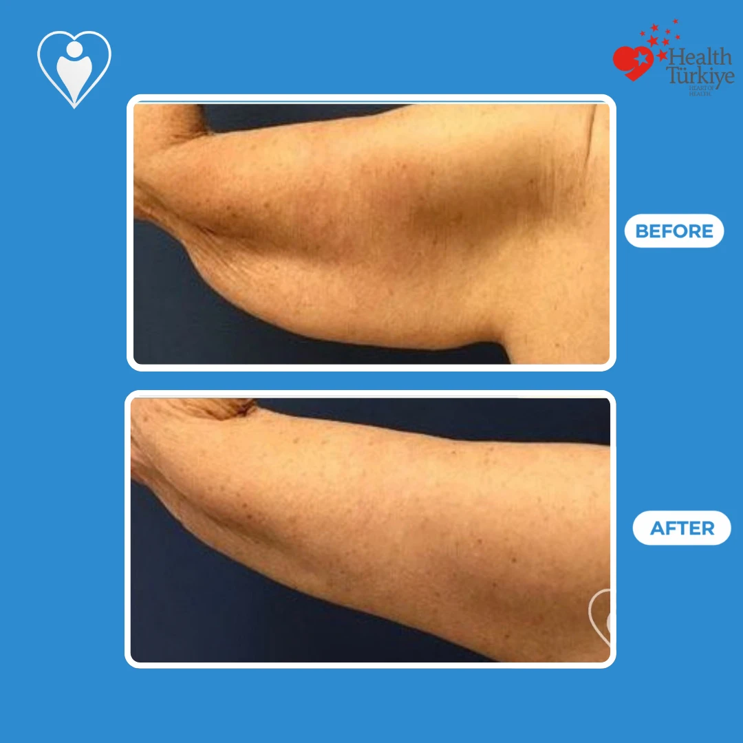 Body contouring before and after: close view of an upper arm with sagging skin before and a smoother, slimmer line after, patient of Prof. Zeynep Sevim, Flymedi.