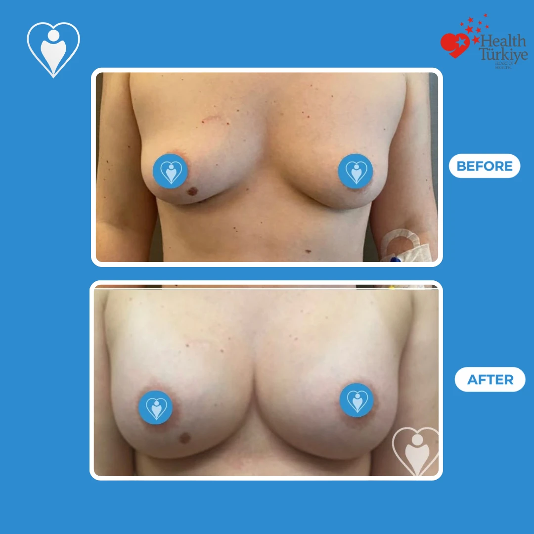 Cosmetic breast surgery before and after: front view of a woman with small breasts before and a fuller shape after, nipples covered, patient of Prof. Zeynep Sevim, Flymedi.