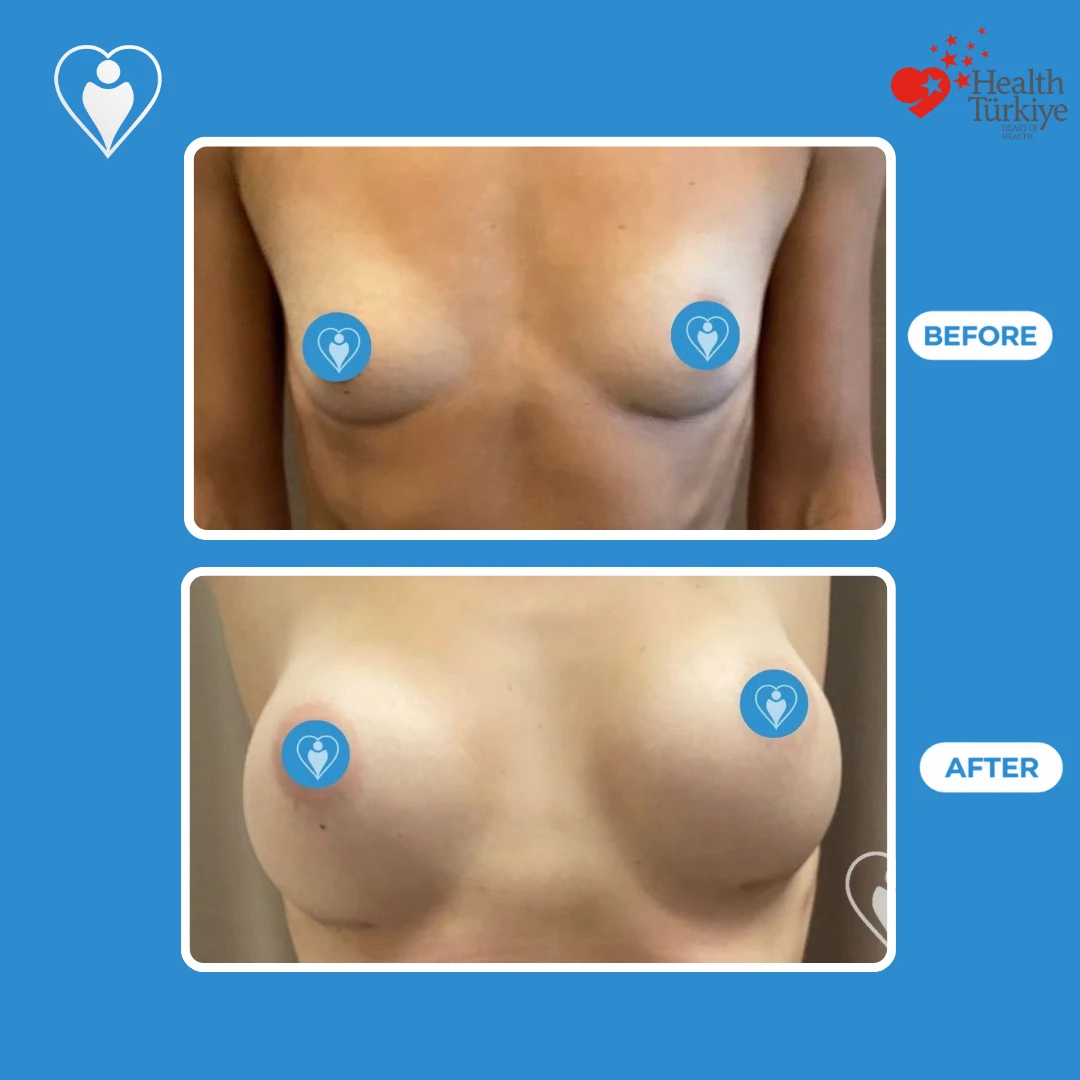 Aesthetic breast surgery before and after: front view of small, wide set breasts before and fuller, rounder breasts after, patient of Prof. Zeynep Sevim, Flymedi.