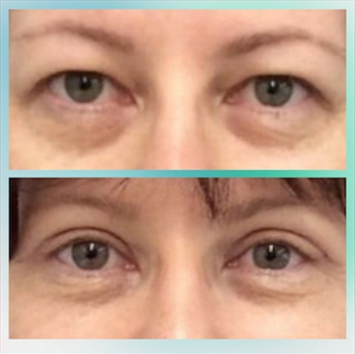 Eyelid Surgery at Luna Clinic Turkey