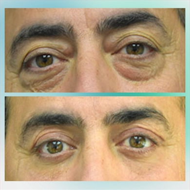 Eyelid Surgery at Luna Clinic Turkey