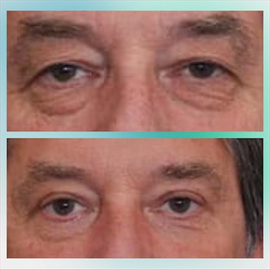 Eyelid Surgery at Luna Clinic Turkey