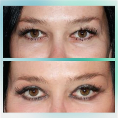 Eyelid Surgery at Luna Clinic Turkey
