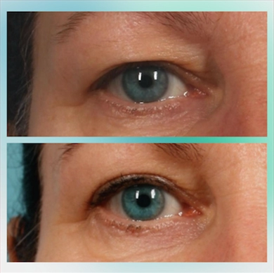 Eyelid Surgery at Luna Clinic Turkey
