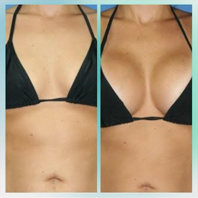 Breast Implants at Luna Clinic Turkey