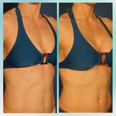 Breast Implants at Luna Clinic Turkey