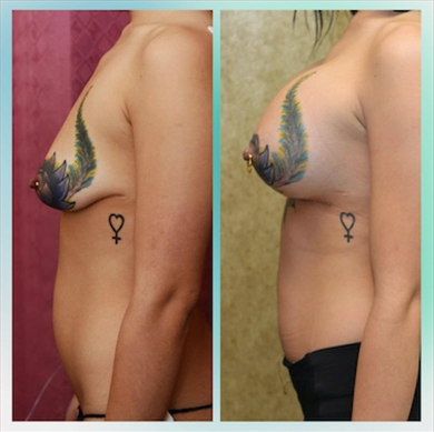 Breast Implants at Luna Clinic Turkey