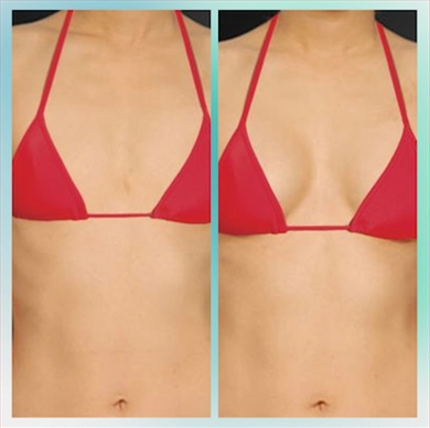 Breast Implants at Luna Clinic Turkey