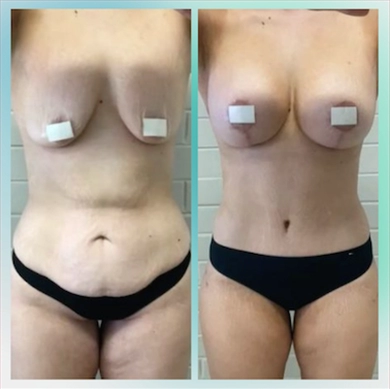 Breast Implants at Luna Clinic Turkey