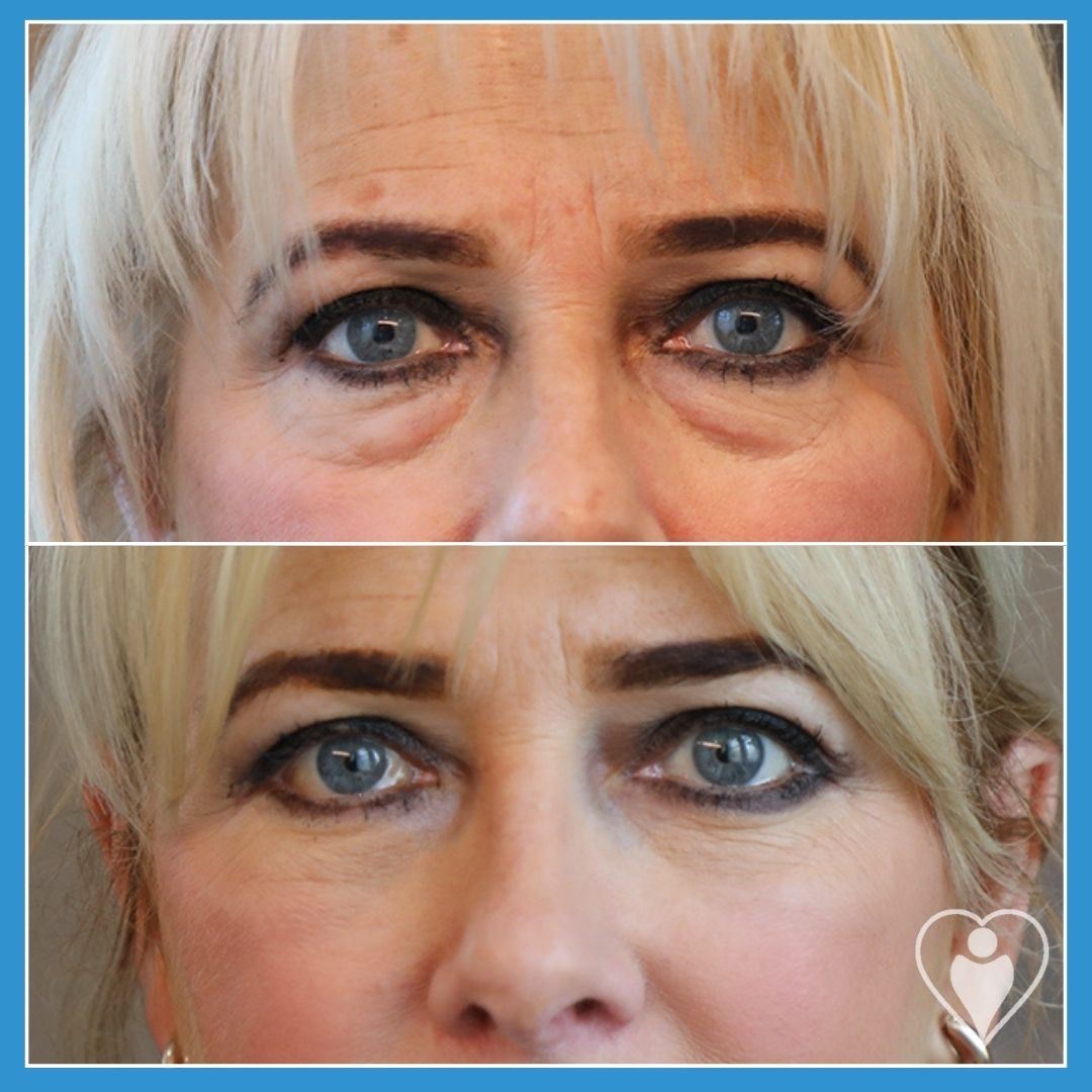 Eyelid Surgery at Luna Clinic Turkey