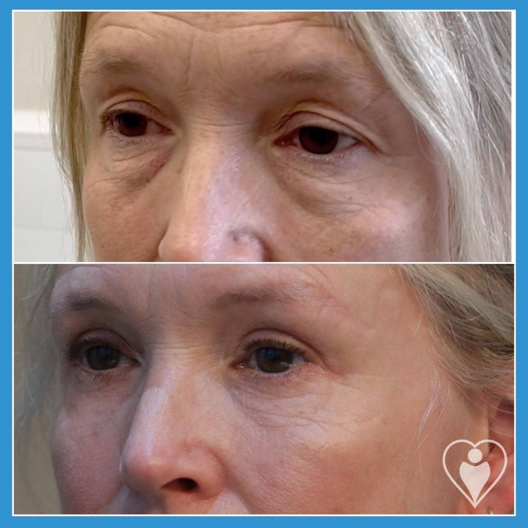 Eyelid Surgery at Luna Clinic Turkey