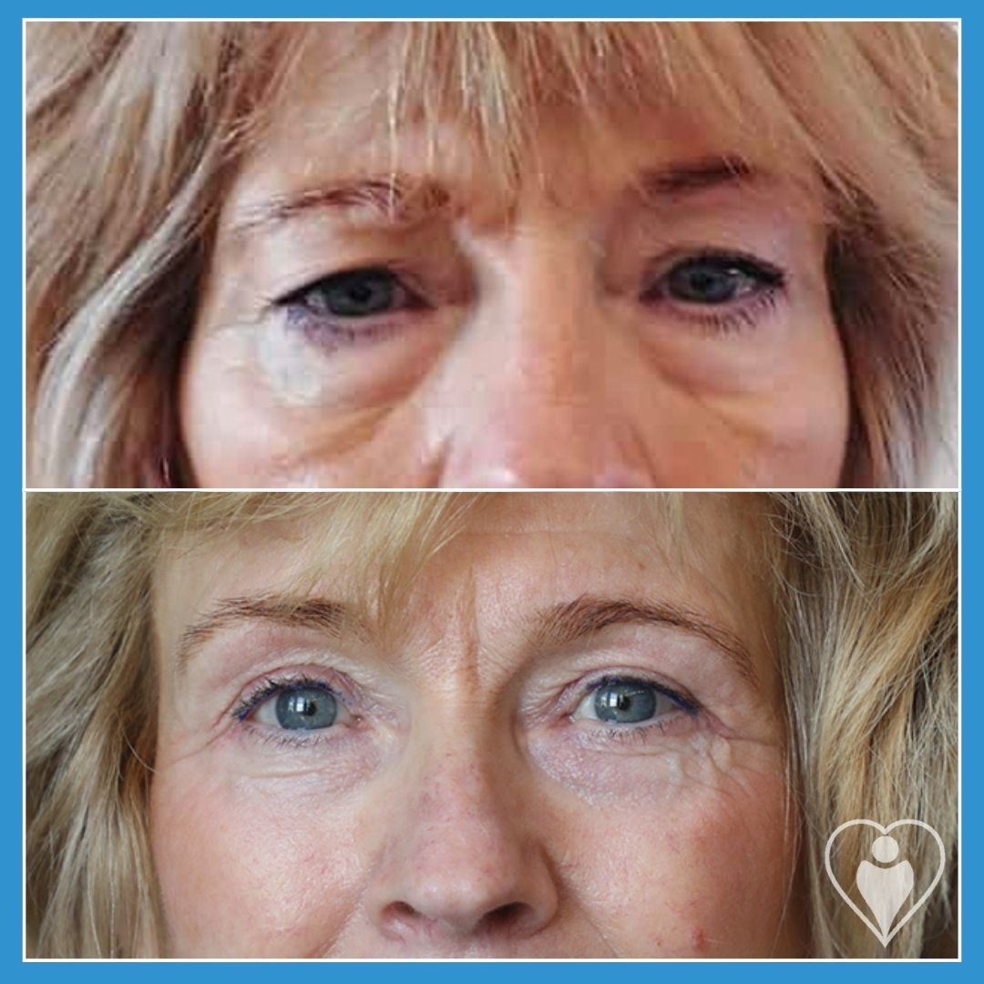 Eyelid Surgery at Istanbul European Clinic