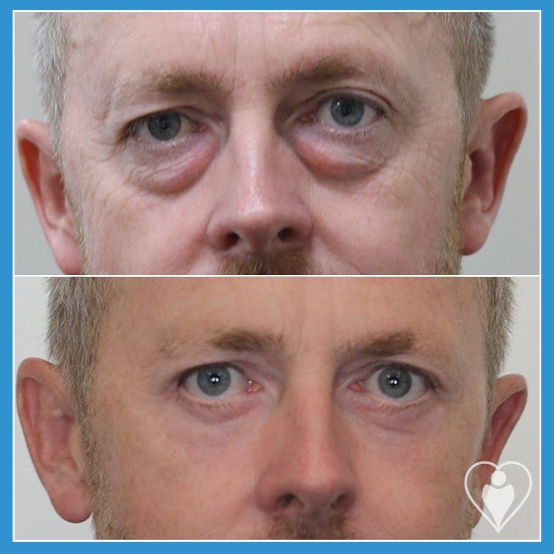 Eyelid Surgery at Istanbul European Clinic