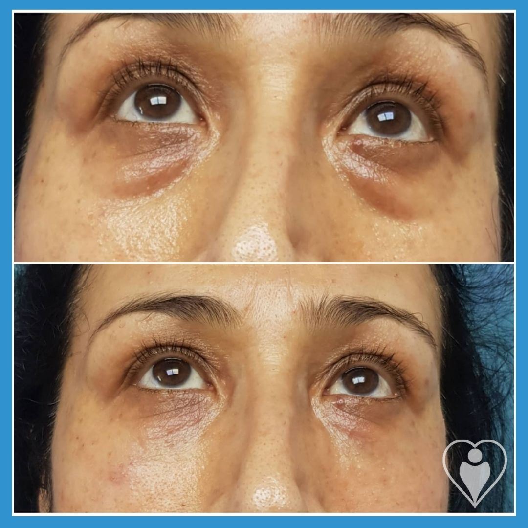 Eyelid Surgery at Luna Clinic Turkey