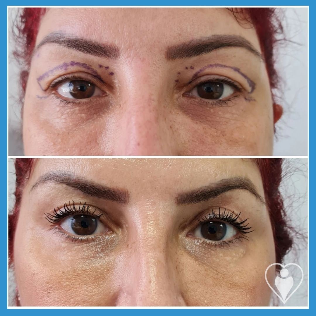 Eyelid Surgery at Istanbul European Clinic