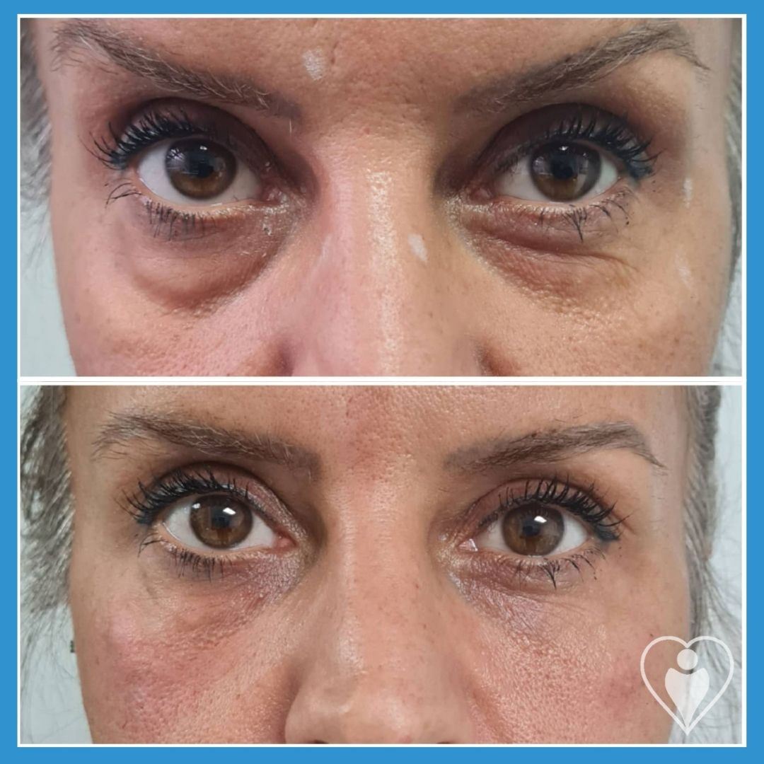 Eyelid Surgery at Istanbul European Clinic